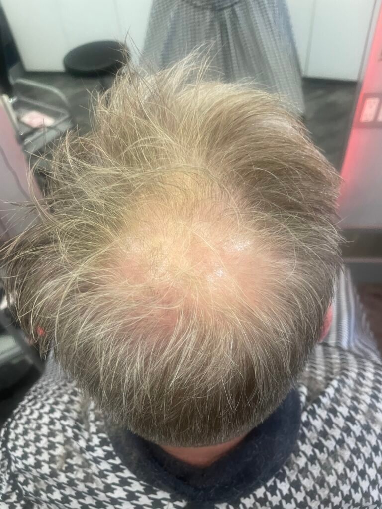 Salon Solutions for Hair Loss