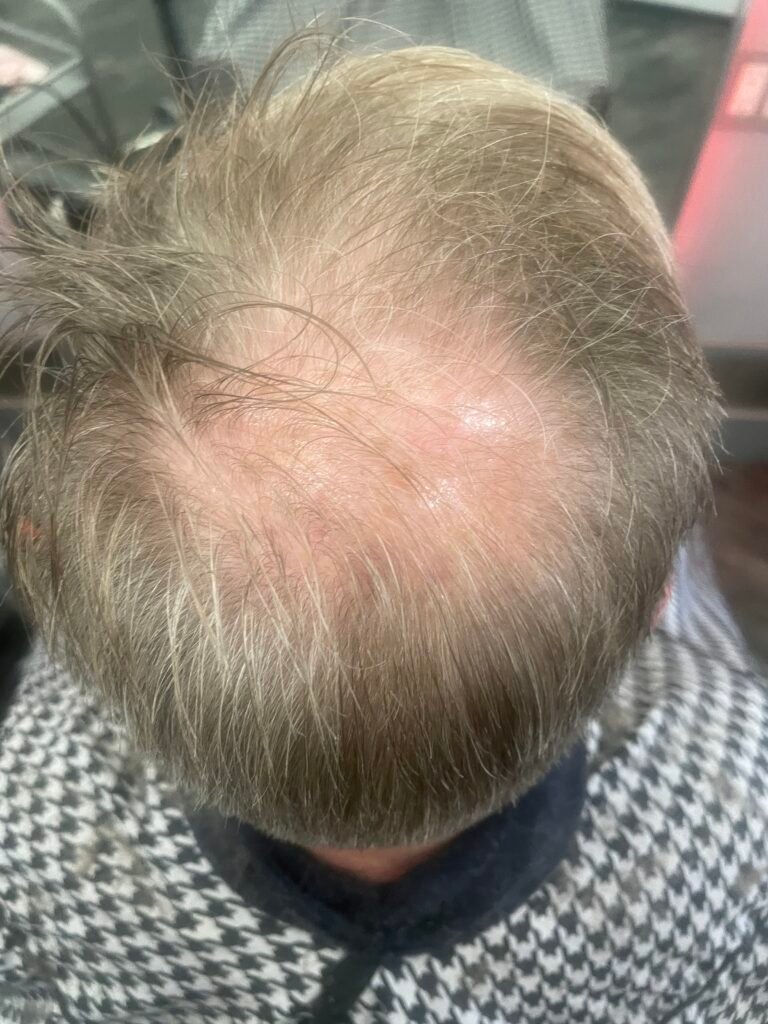 Thinning hair